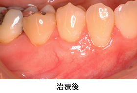 歯肉退縮結合組織移植治療後