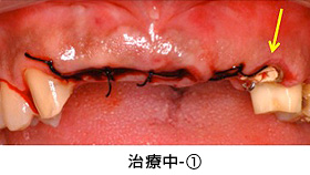 case2．矯正的挺出と歯冠延長術の併用治療中①