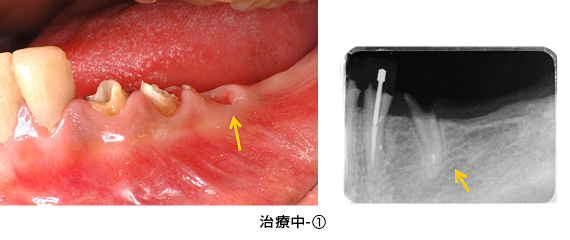Ｃａｓｅ３矯正的挺出と遊離歯肉移植術の併用症例治療中1