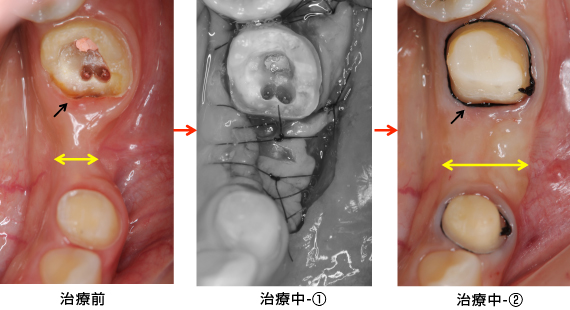 Ｃａｓｅ4．歯冠延長術と遊離歯肉移植の併用症例治療前、治療中