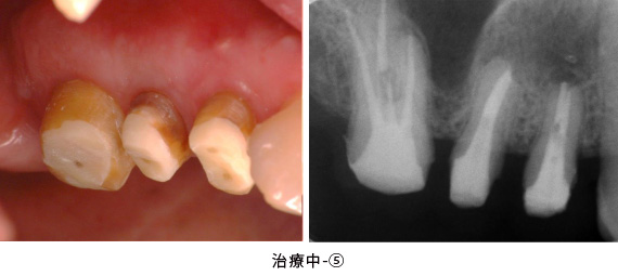 歯根端切除術と歯冠延長術の併用症例治療中-⑤