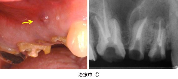歯根端切除術と歯冠延長術の併用症例治療中-①