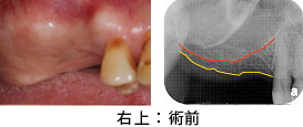 Ｃａｓｅ7．両側臼歯部のインプラント治療（サイナスリフト＋ＧＢＲ）9