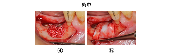 Ｃａｓｅ7．両側臼歯部のインプラント治療（サイナスリフト＋ＧＢＲ）15