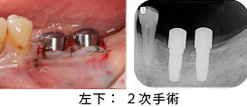 Ｃａｓｅ7．両側臼歯部のインプラント治療（サイナスリフト＋ＧＢＲ）21
