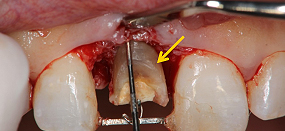Case５.上顎前歯の矯正的挺出_11