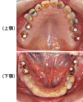 Ｃａｓｅ7．両側臼歯部のインプラント治療（サイナスリフト＋ＧＢＲ）26