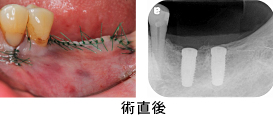 Ｃａｓｅ7．両側臼歯部のインプラント治療（サイナスリフト＋ＧＢＲ）13