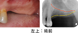 Ｃａｓｅ7．両側臼歯部のインプラント治療（サイナスリフト＋ＧＢＲ）5