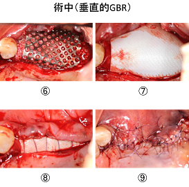 Ｃａｓｅ８．左上臼歯部のインプラント治療（サイナスリフト+垂直的GBR）_5