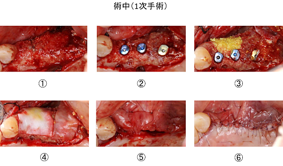 Ｃａｓｅ８．左上臼歯部のインプラント治療（サイナスリフト+垂直的GBR）_8