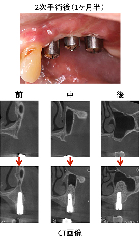 Ｃａｓｅ８．左上臼歯部のインプラント治療（サイナスリフト+垂直的GBR）_11
