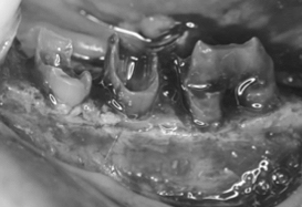 Ｃａｓｅ６.歯冠延長術と遊離歯肉移植の併用症例_3
