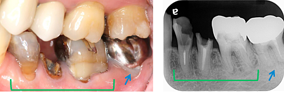 Ｃａｓｅ6.歯冠延長術と遊離歯肉移植の併用症例_1
