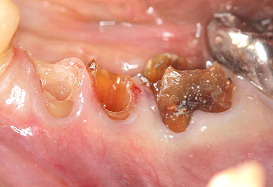 Ｃａｓｅ６.歯冠延長術と遊離歯肉移植の併用症例_2