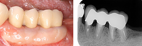Ｃａｓｅ６.歯冠延長術と遊離歯肉移植の併用症例_7