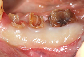 Ｃａｓｅ６.歯冠延長術と遊離歯肉移植の併用症例_5