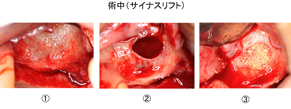 Ｃａｓｅ８．左上臼歯部のインプラント治療（サイナスリフト+垂直的GBR）_3