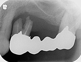 Ｃａｓｅ８．左上臼歯部のインプラント治療（サイナスリフト+垂直的GBR）_1