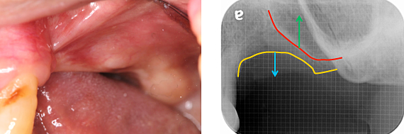 Ｃａｓｅ８．左上臼歯部のインプラント治療（サイナスリフト+垂直的GBR）_2