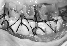 Ｃａｓｅ６.歯冠延長術と遊離歯肉移植の併用症例_4